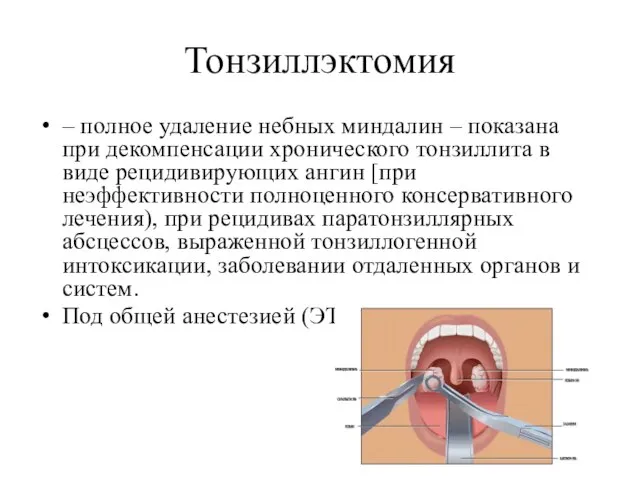 Тонзиллэктомия – полное удаление небных миндалин – показана при декомпенсации хронического