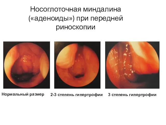 Носоглоточная миндалина («аденоиды») при передней риноскопии Нормальный размер 2-3 степень гипертрофии 3 степень гипертрофии