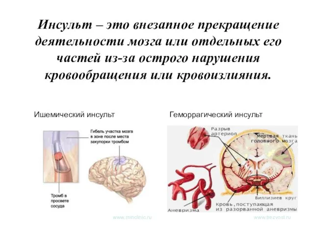 Инсульт – это внезапное прекращение деятельности мозга или отдельных его частей