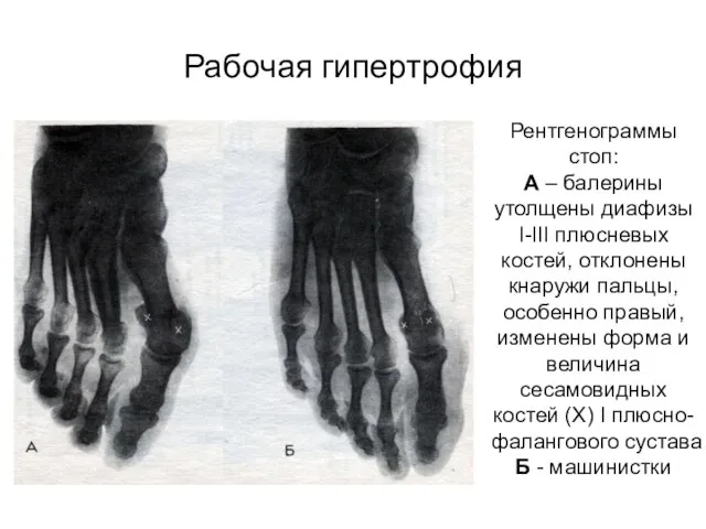 Рабочая гипертрофия Рентгенограммы стоп: А – балерины утолщены диафизы I-III плюсневых