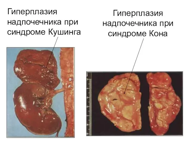 Гиперплазия надпочечника при синдроме Кушинга Гиперплазия надпочечника при синдроме Кона