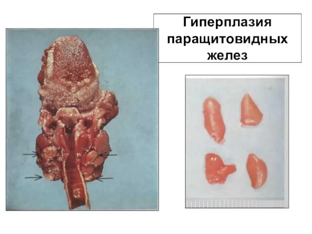 Гиперплазия паращитовидных желез