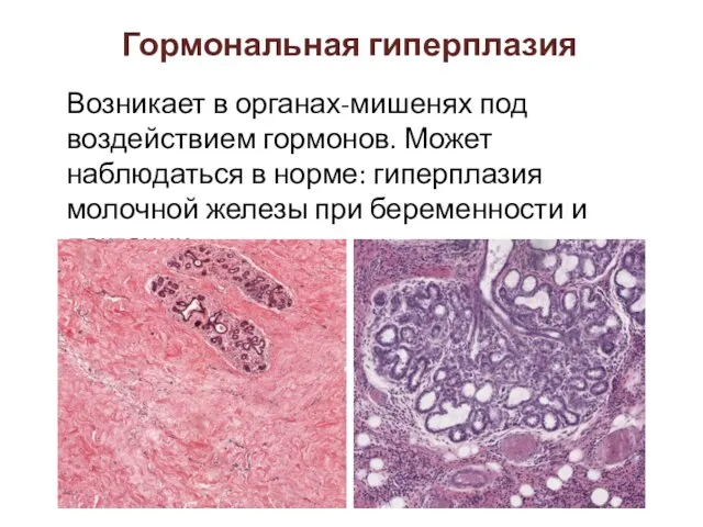 Возникает в органах-мишенях под воздействием гормонов. Может наблюдаться в норме: гиперплазия