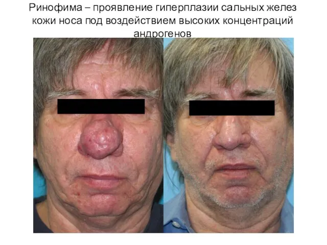Ринофима – проявление гиперплазии сальных желез кожи носа под воздействием высоких концентраций андрогенов