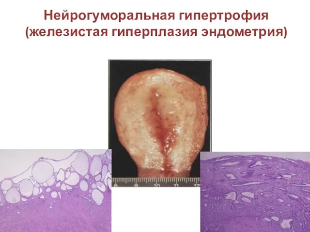 Нейрогуморальная гипертрофия (железистая гиперплазия эндометрия)