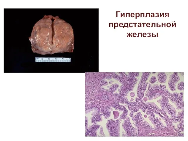 Гиперплазия предстательной железы