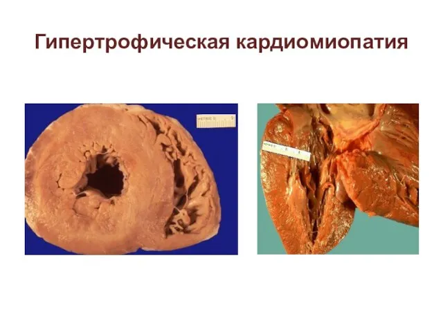 Гипертрофическая кардиомиопатия