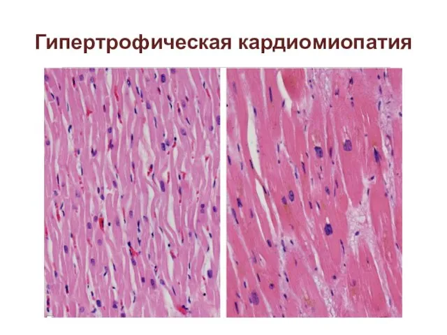 Гипертрофическая кардиомиопатия