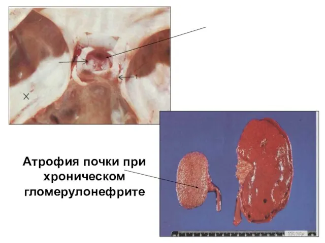 Атрофия почки при хроническом гломерулонефрите