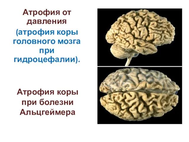 Атрофия от давления (атрофия коры головного мозга при гидроцефалии). Атрофия коры при болезни Альцгеймера