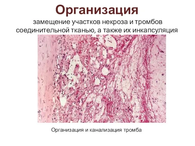 Организация замещение участков некроза и тромбов соединительной тканью, а также их инкапсуляция Организация и канализация тромба