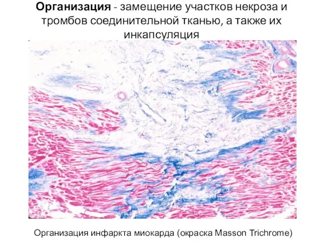 Организация - замещение участков некроза и тромбов соединительной тканью, а также