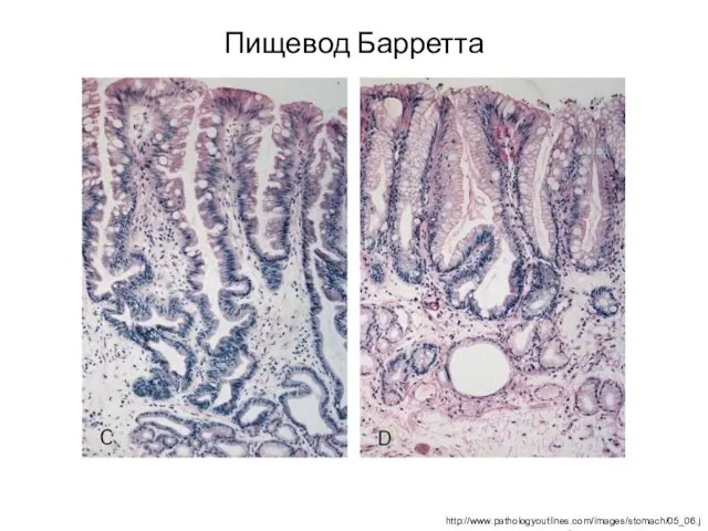 Пищевод Барретта http://www.pathologyoutlines.com/images/stomach/05_06.jpg