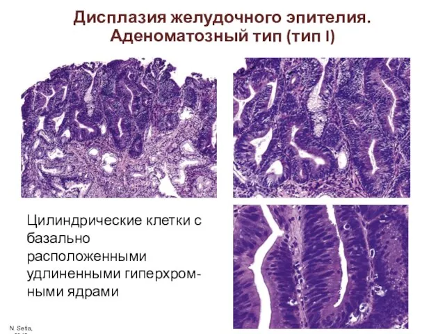 Цилиндрические клетки с базально расположенными удлиненными гиперхром-ными ядрами Дисплазия желудочного эпителия.