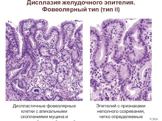 Диспластичные фовеолярные клетки с апикальными скоплениями муцина и выраженной ядерной атипией