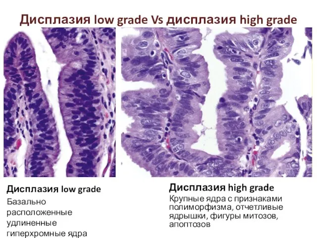 Дисплазия low grade Базально расположенные удлиненные гиперхромные ядра Дисплазия low grade