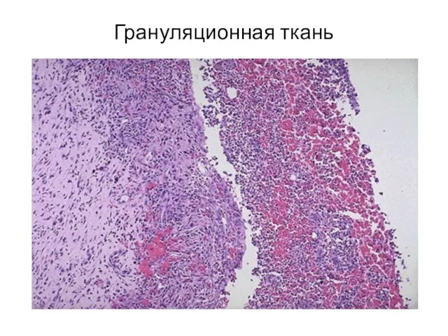 Грануляционная ткань