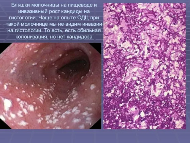 Бляшки молочницы на пищеводе и инвазивный рост кандиды на гистологии. Чаще