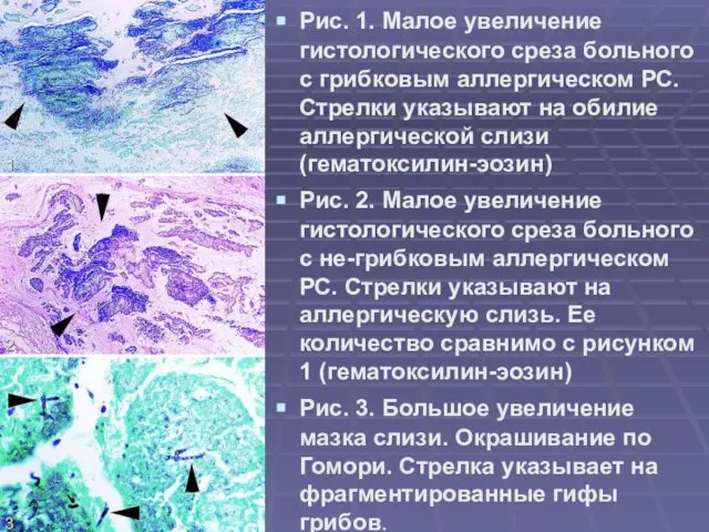 Рис. 1. Малое увеличение гистологического среза больного с грибковым аллергическом РС.