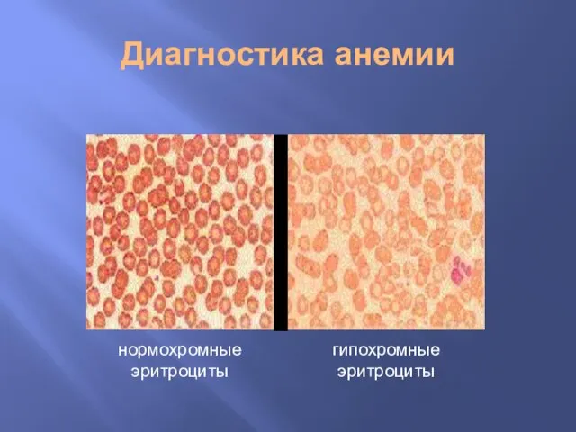 Диагностика анемии нормохромные эритроциты гипохромные эритроциты