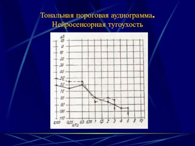 Тональная пороговая аудиограмма. Нейросенсорная тугоухость