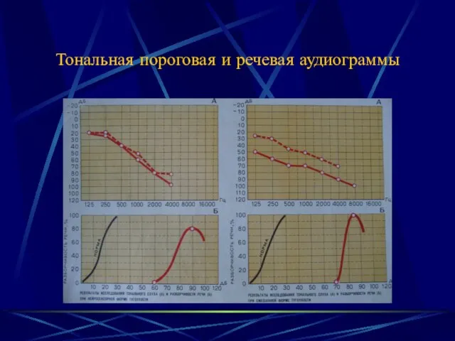 Тональная пороговая и речевая аудиограммы