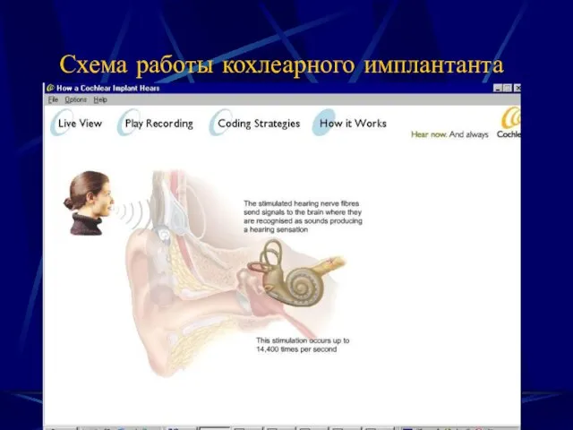 Схема работы кохлеарного имплантанта