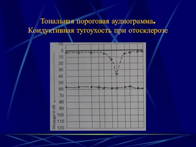 Тональная пороговая аудиограмма. Кондуктивная тугоухость при отосклерозе