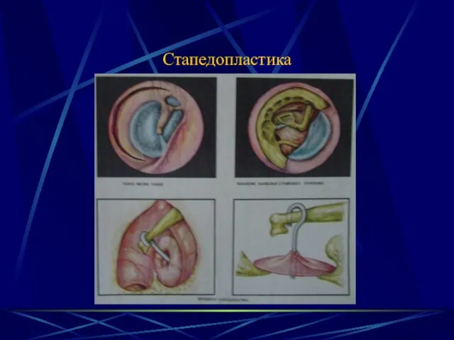 Стапедопластика