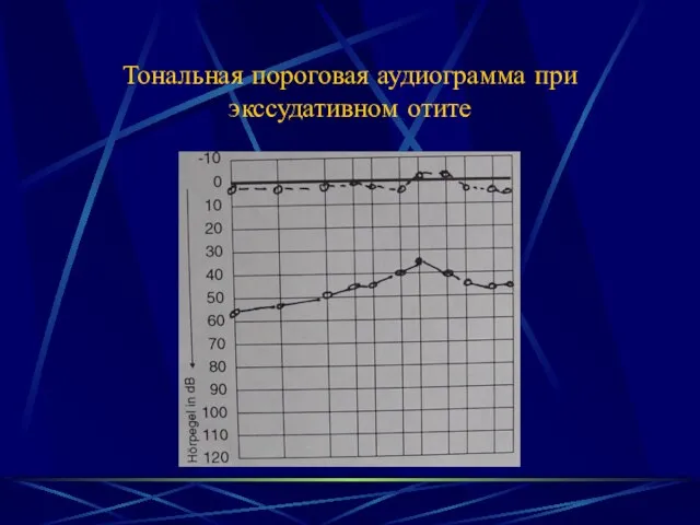 Тональная пороговая аудиограмма при экссудативном отите