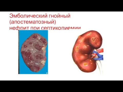 Эмболический гнойный (апостематозный) нефрит при септикопиемии