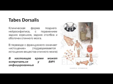 Tabes Dorsalis Клиническая форма позднего нейросифилиса, с поражением задних корешков, задних