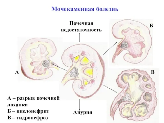 Мочекаменная болезнь Почечная недостаточность Анурия А Б В А – разрыв