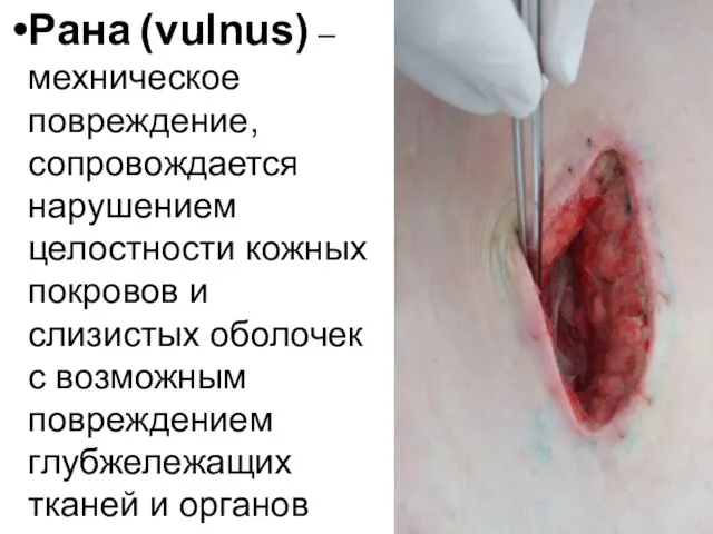 Рана (vulnus) – мехническое повреждение, сопровождается нарушением целостности кожных покровов и
