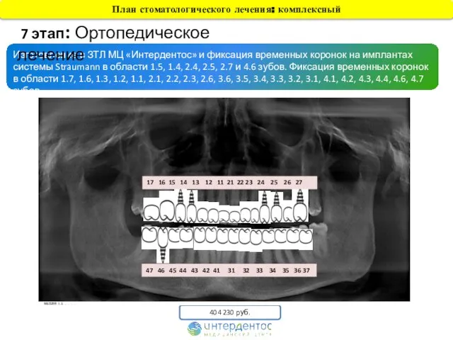 Изготовление в ЗТЛ МЦ «Интердентос» и фиксация временных коронок на имплантах