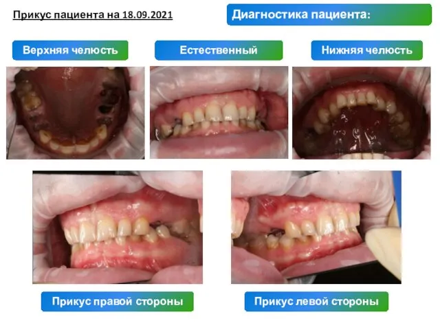 Прикус пациента на 18.09.2021 Естественный прикус Нижняя челюсть Диагностика пациента: Верхняя