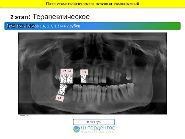 Лечение кариеса 1.6, 1.7, 1.3 и 4.7 зубов. 2 этап: Терапевтическое