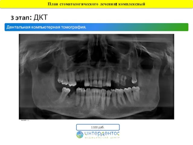 Дентальная компьютерная томография. 3 этап: ДКТ 1100 руб. План стоматологического лечения: комплексный