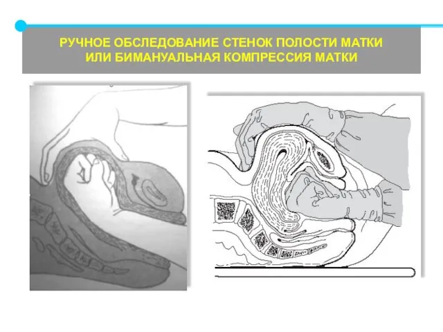 РУЧНОЕ ОБСЛЕДОВАНИЕ СТЕНОК ПОЛОСТИ МАТКИ ИЛИ БИМАНУАЛЬНАЯ КОМПРЕССИЯ МАТКИ