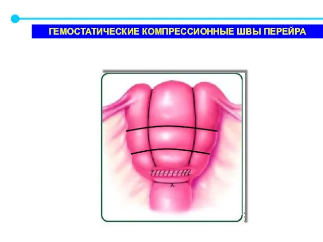 ГЕМОСТАТИЧЕСКИЕ КОМПРЕССИОННЫЕ ШВЫ ПЕРЕЙРА