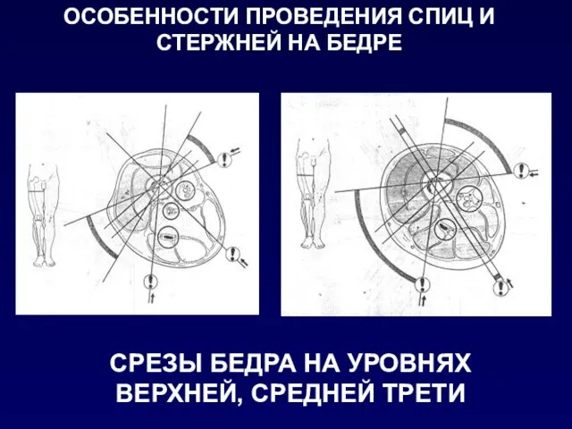 ОСОБЕННОСТИ ПРОВЕДЕНИЯ СПИЦ И СТЕРЖНЕЙ НА БЕДРЕ СРЕЗЫ БЕДРА НА УРОВНЯХ ВЕРХНЕЙ, СРЕДНЕЙ ТРЕТИ