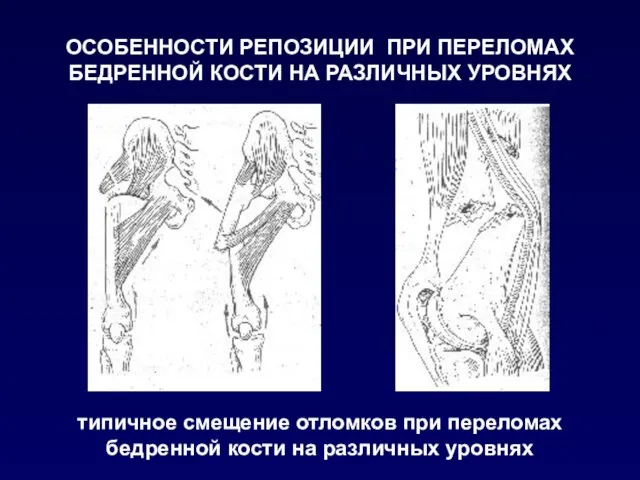 ОСОБЕННОСТИ РЕПОЗИЦИИ ПРИ ПЕРЕЛОМАХ БЕДРЕННОЙ КОСТИ НА РАЗЛИЧНЫХ УРОВНЯХ типичное смещение