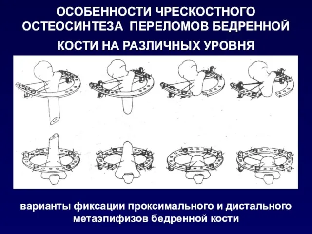 ОСОБЕННОСТИ ЧРЕСКОСТНОГО ОСТЕОСИНТЕЗА ПЕРЕЛОМОВ БЕДРЕННОЙ КОСТИ НА РАЗЛИЧНЫХ УРОВНЯ варианты фиксации