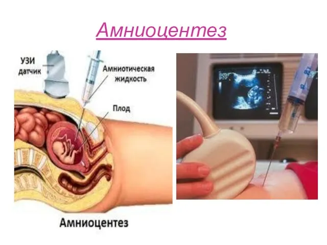 Амниоцентез