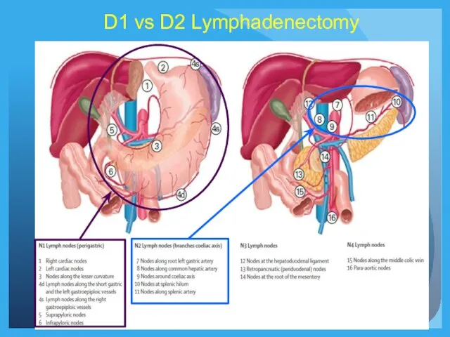 D1 vs D2 Lymphadenectomy