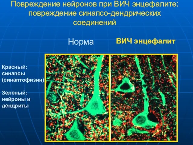 Повреждение нейронов при ВИЧ энцефалите: повреждение синапсо-дендрических соединений Норма ВИЧ энцефалит