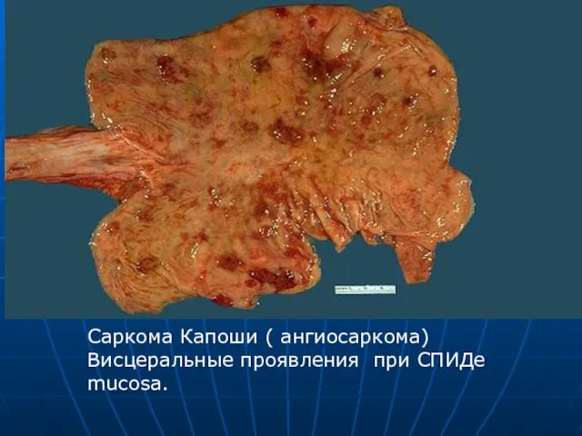Саркома Капоши ( ангиосаркома) Висцеральные проявления при СПИДе mucosa.