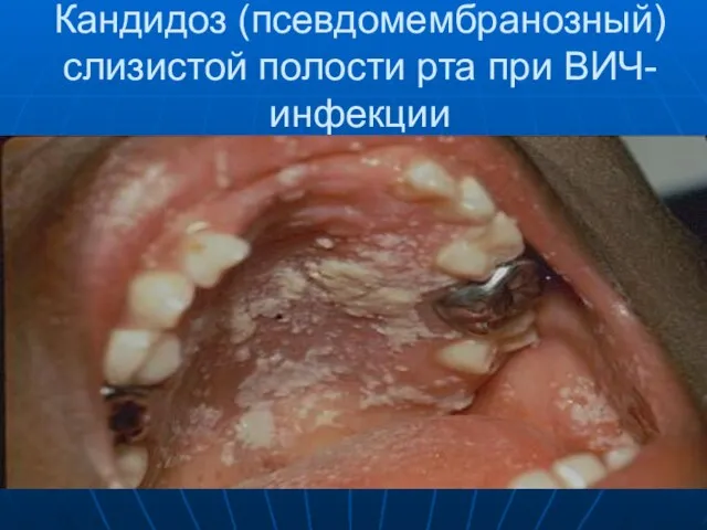 Кандидоз (псевдомембранозный) слизистой полости рта при ВИЧ-инфекции