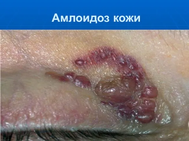 Амлоидоз кожи