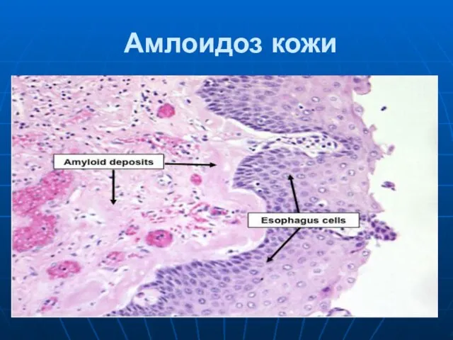 Амлоидоз кожи